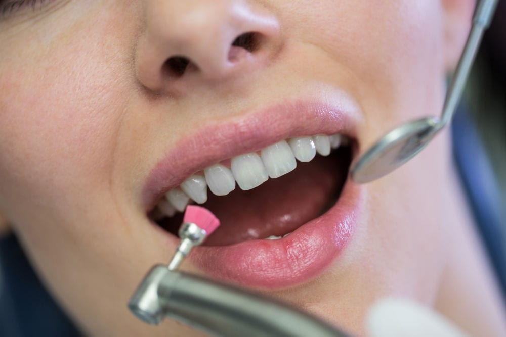 A dentist polishing a patient's teeth during a professional clean