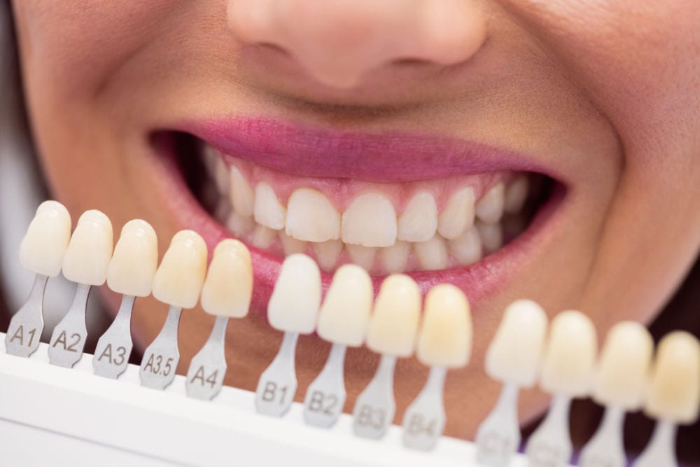 A shade guide held up to a patient's smile to match a crown or implant