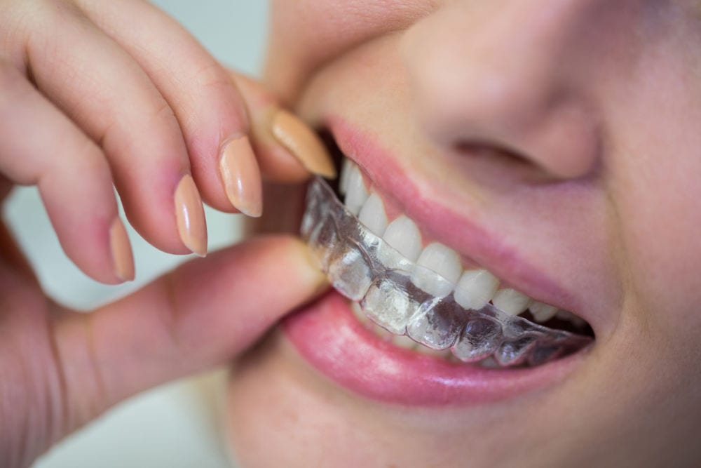 A patient fitting a clear aligner over their teeth